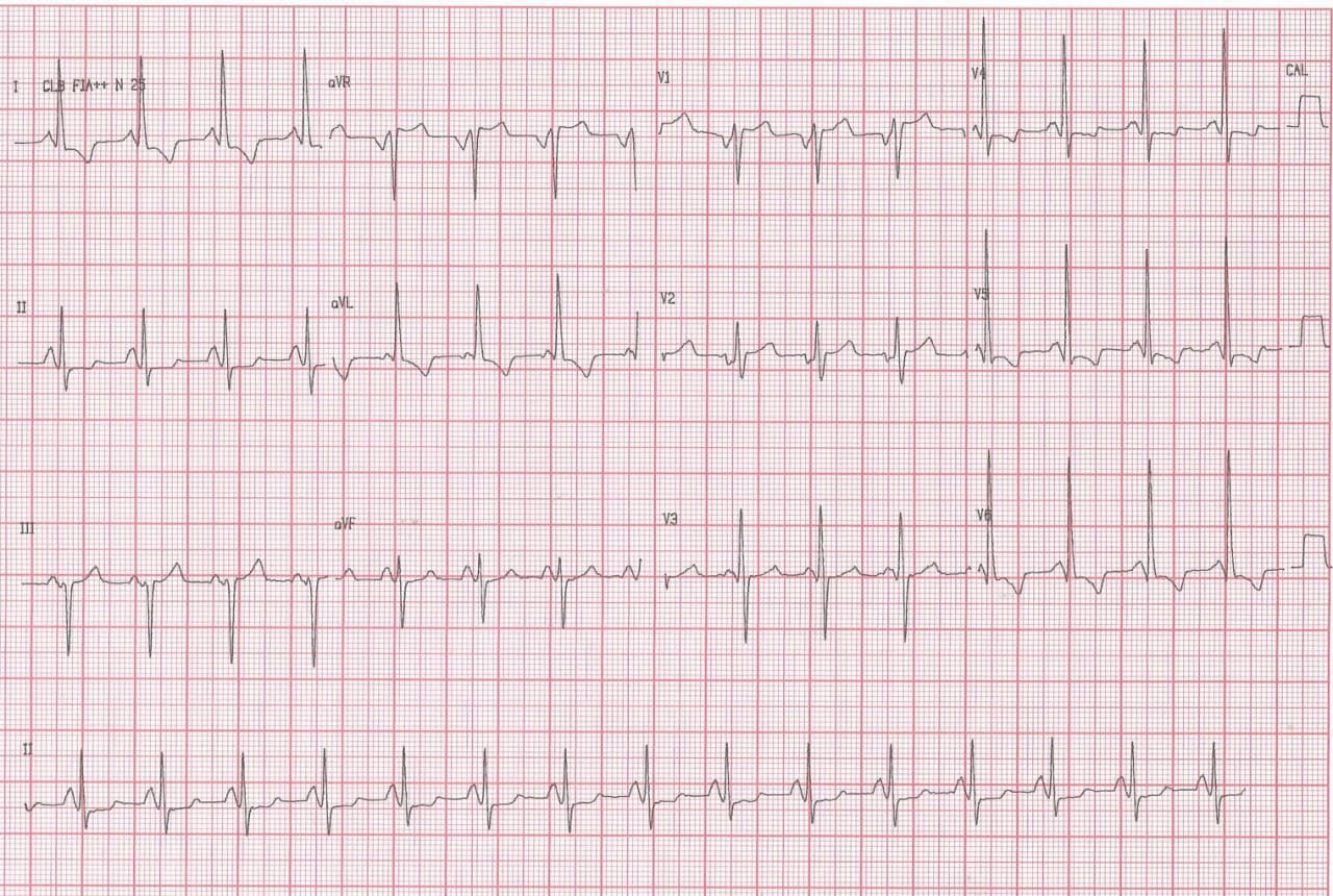 Mujer de 41 años portadora de insuficiencia renal crónica que presenta síncope y disnea mostrando HVI y PR corto por Enfermedad de Fabry