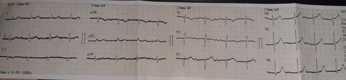Mujer de 83 años cursando infección por COVID 19 en tratamiento con cloroquina que comienza con mareos y que presenta BAV de 1º o BAV 2:1 en el trazado disponible