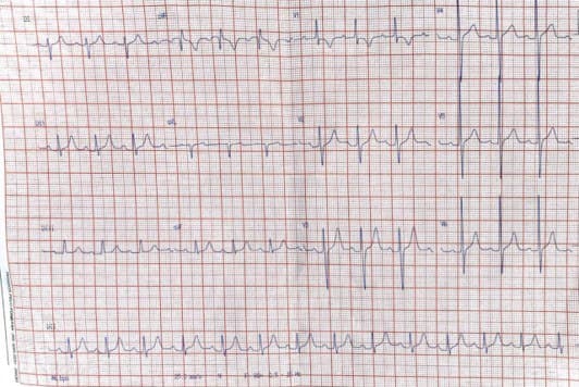 Hombre de 23 años que presenta latido paraesternal derecho con signos de crecimiento de cavidades derechas e HTP debido a CIA-OS con shunt de izquierda a derecha