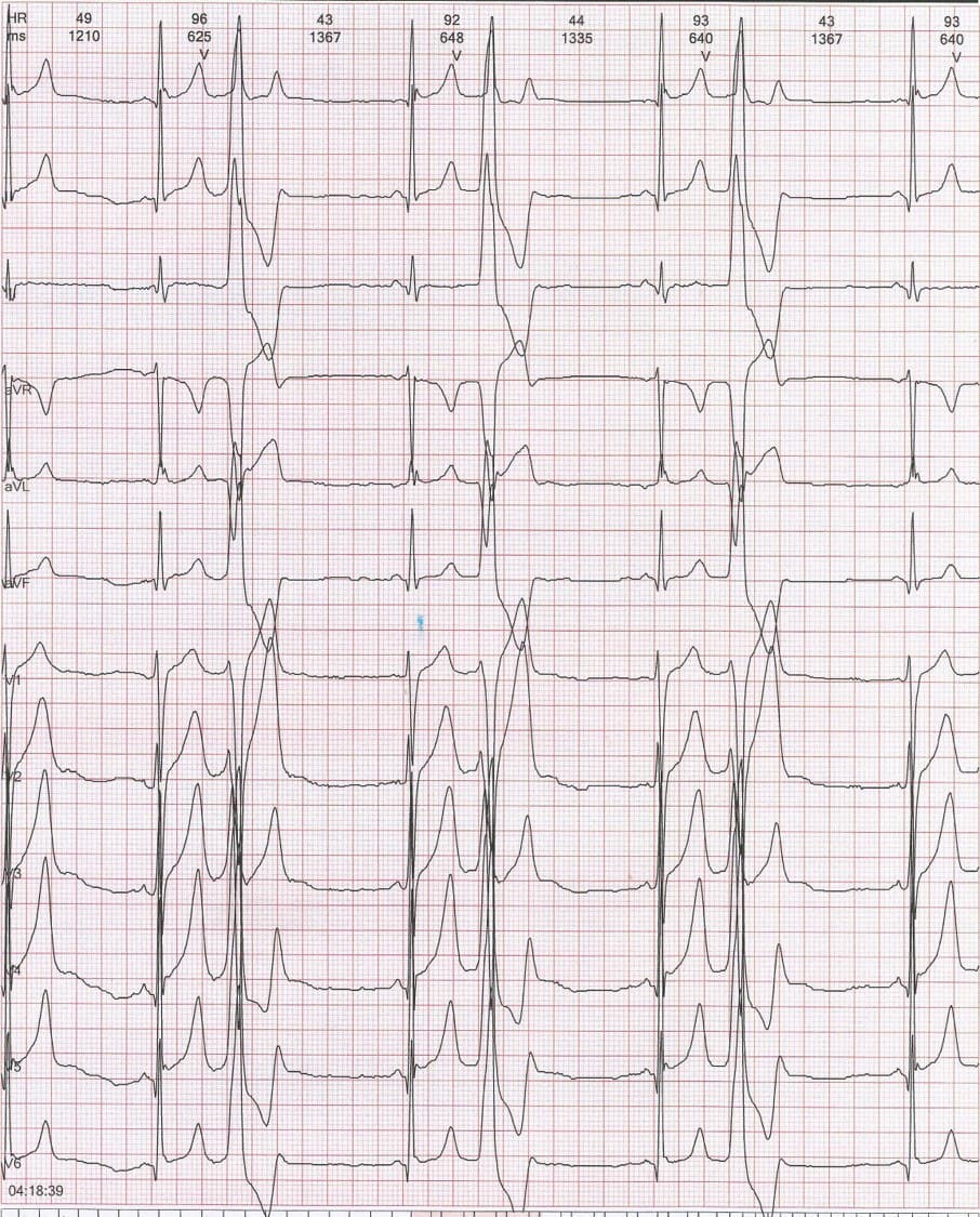Hombre de 21 años que presenta palpitaciones por bigeminia persistente que desarrolla taquicardia ventricular autolimitada a 300 LPM