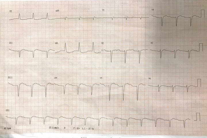 Paciente masculino de 69 años portador de FA crónica tratado con digoxina que presenta insuficiencia cardíaca con incremento de la disnea en los últimos días que presenta ritmo de la unión y EV bigeminada por intoxicación digitálica