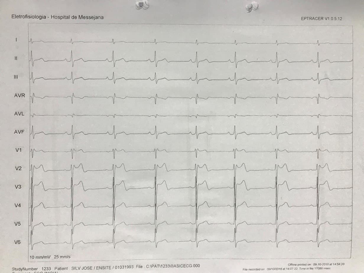 Hombre joven que presenta episodio sincopal y que muestra ECG con patente Brugada tipo II y quién en EEF repite síncope al desencadenarse TV y FV
