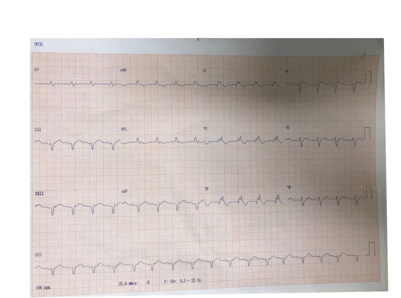Paciente de 62 años hipertenso y diabético que presenta episodio de ángor prolongado seguido de FV de la cuál es recuperado con CVE por compromiso de la DA