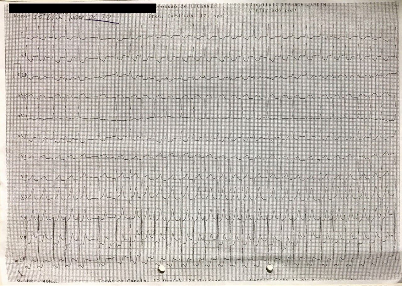 Mujer de 68 años, HTA tratada irregularmente que cursa con episodio de ángor prolongado, con arterias coronarias angiográficamente normales en quién se constata estenosis aórtica severa