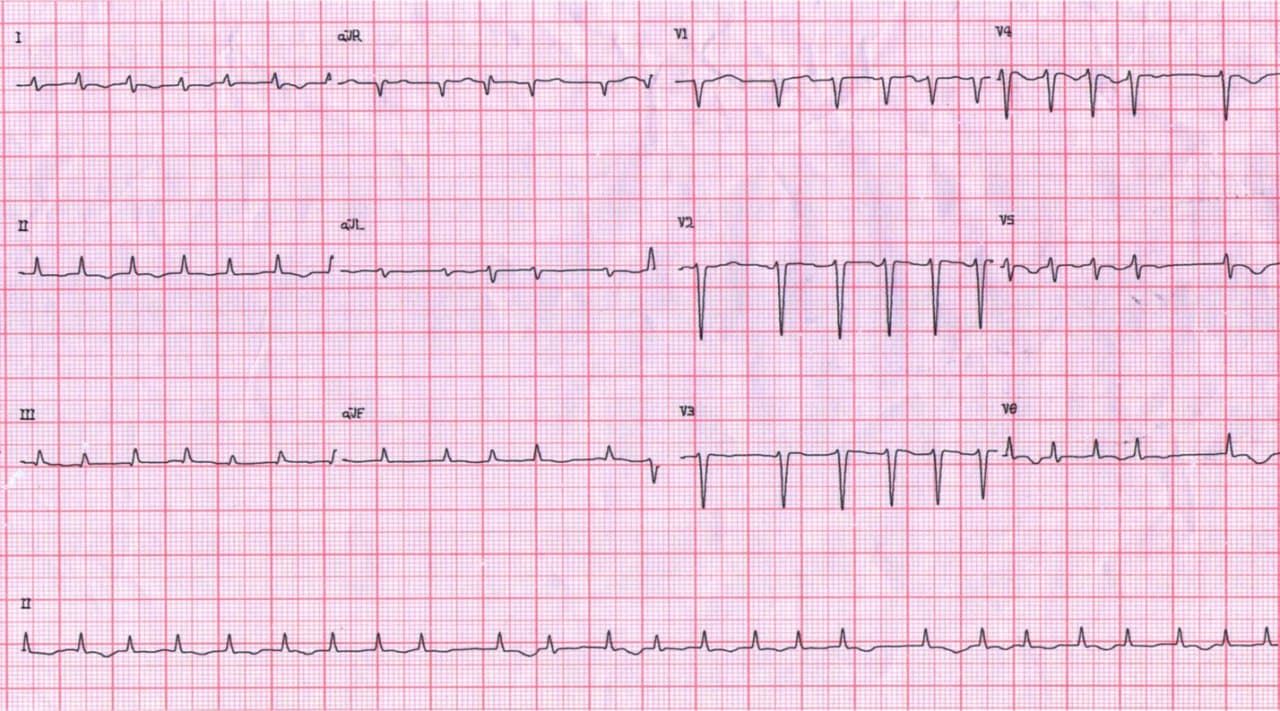 Paciente femenina de 75 años que presenta disnea asociada a infección respiratoria que es tratada con azitromicina con desarrollo ulterior de QTL y Torsade de Pointes que logran controlarse con sulfato de magnesio