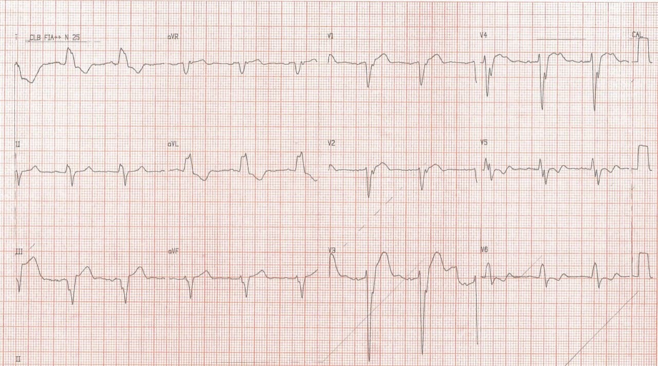 Paciente con cuadro de insuficiencia cardíaca y BCRI crónicos en cuyo ECG se observa signo de Cabrera, indicativo de enfermedad coronaria crónica subyacente