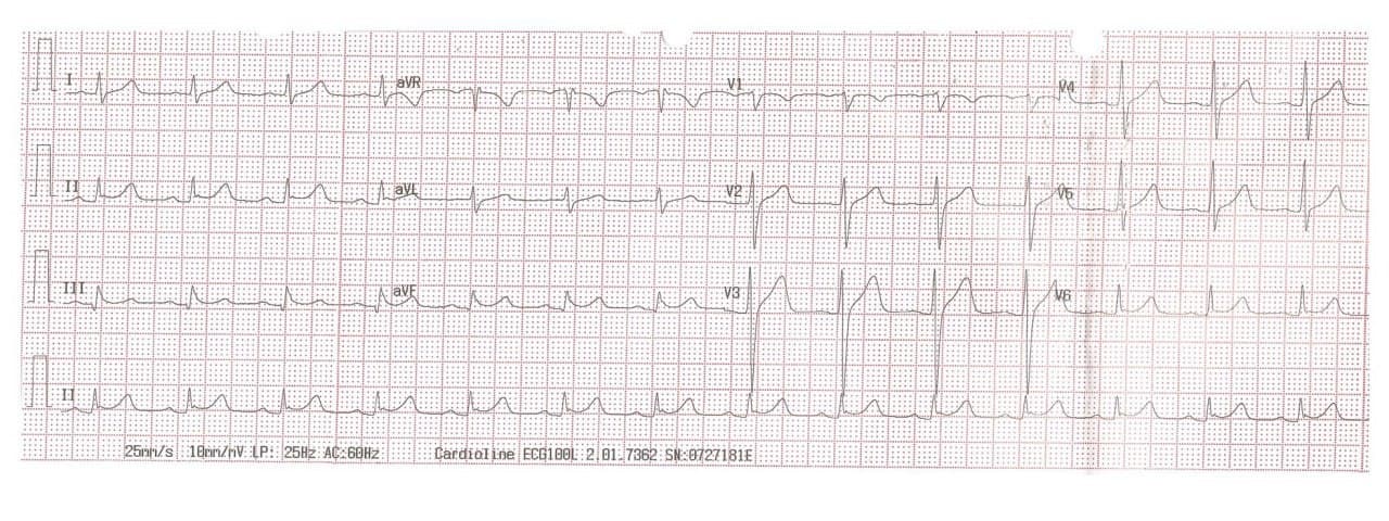 Paciente masculino de 37 años que ingresa a Emergencias en paro cardiorespiratorio debido a FV que es revertida, constatándose ECG compatible con Repolarización Precoz maligna