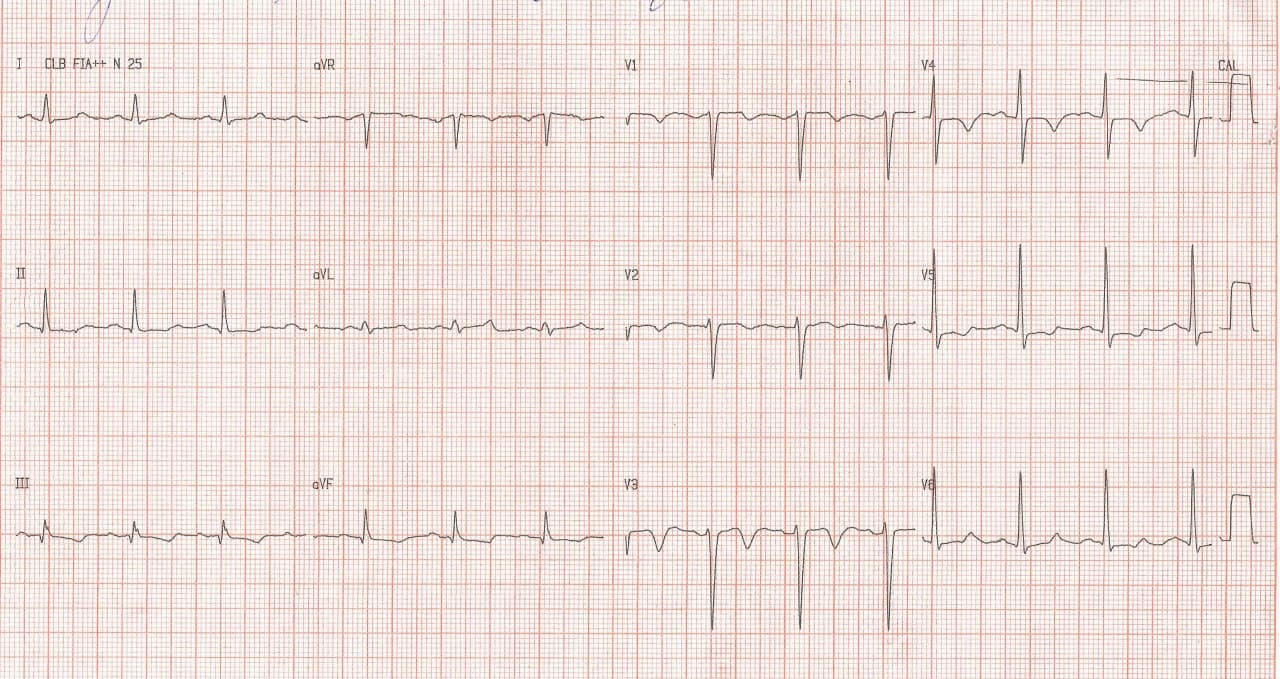 Hombre de 68 años, HTA, asintomático, que realiza ECG de rutina que presenta BCRI intermnitente en fase 3, con ondas T negativas expresión de memoria cardíaca