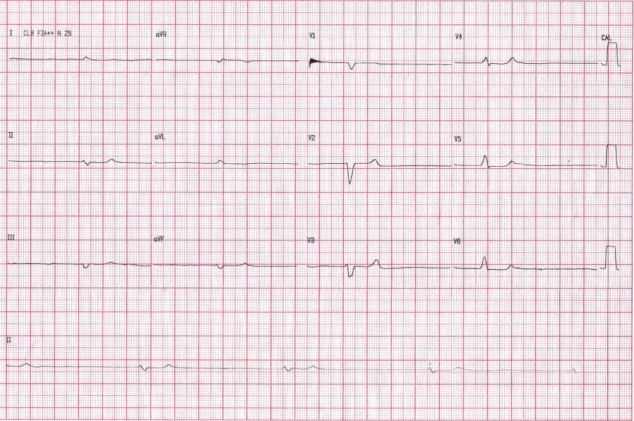 Mujer de 88 años con FA crónica, insuficiencia renal crónica que se halla alertagada y que presenta severa hiperK + hipoCa con desarrollo de derrame pericárdico y que mejora post sesión de hemodiálisis