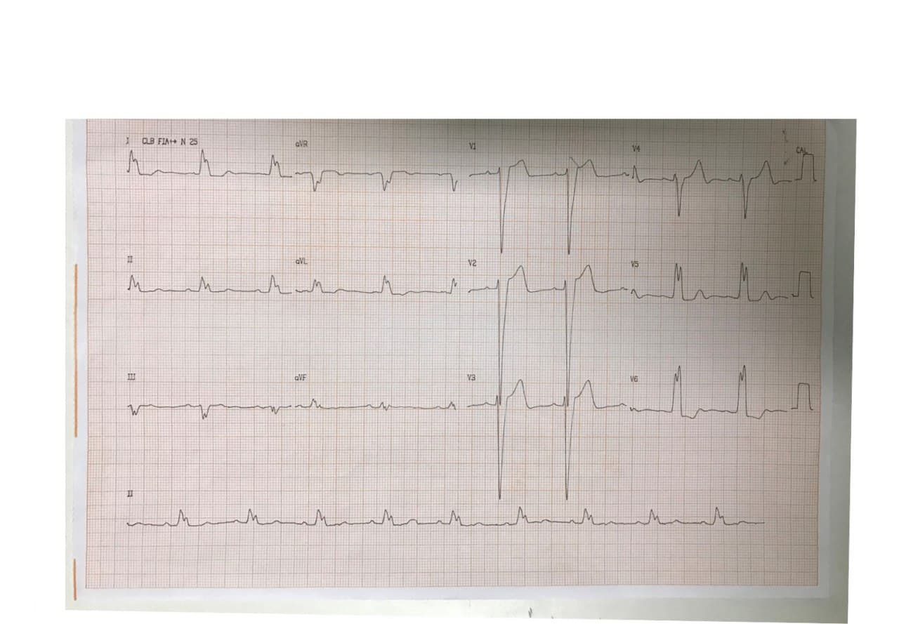Mujer de 81 años con mareos que presenta BAV2:1 asociado a BCRI por compromiso proximal de DA