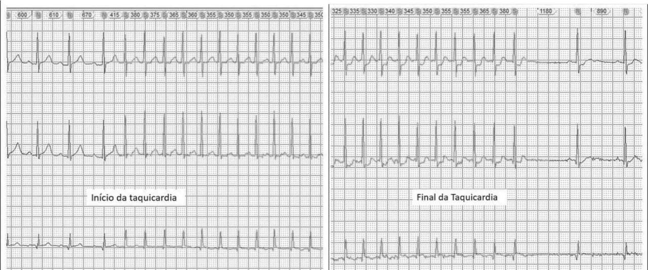 Mujer de 28 años con gesta de 30 semanas que presenta palpitaciones debidas a TRAVO
