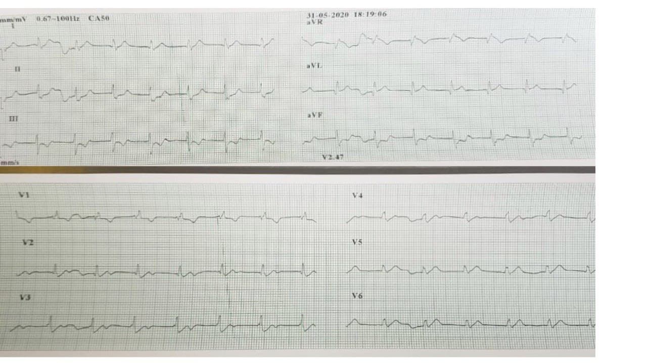 Hombre de 38 años con episodio de ángor que presenta un ECG típico de lesión de TCI por presencia de oclusión con trombo que se extiende a nacimiento de DA y Cx