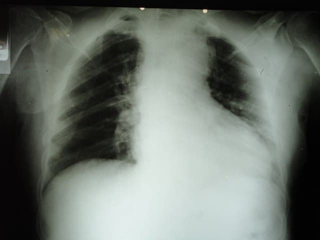 Paciente masculino hipertenso de 62 años con pérdida fugaz de la consciencia que presenta disección aórtica tipo A