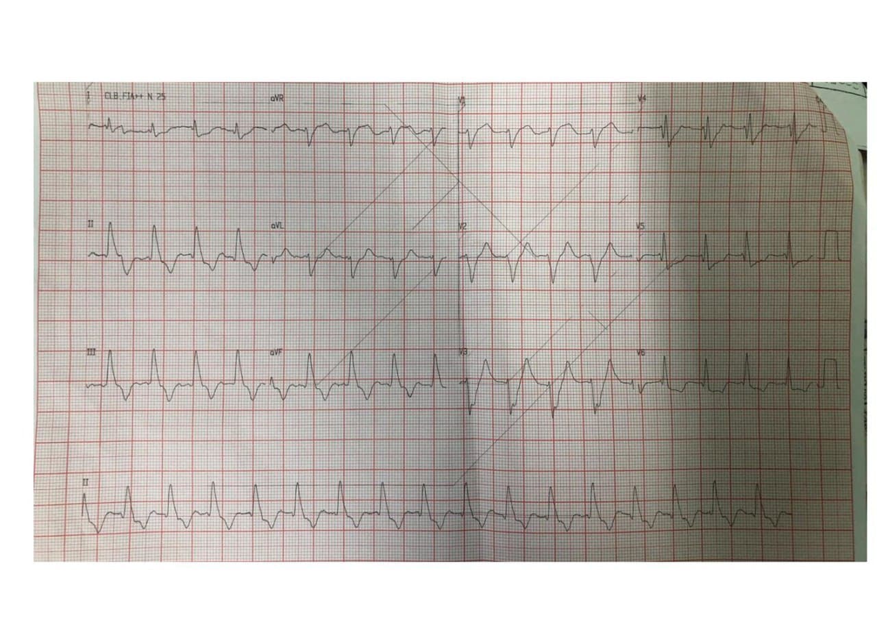 Paciente masculino que presenta episodio de ángor y desarrolla paro cardiorespiratorio en quién se constata TV con cifras elevadas de urea y creatinina y severa hiperkalemia