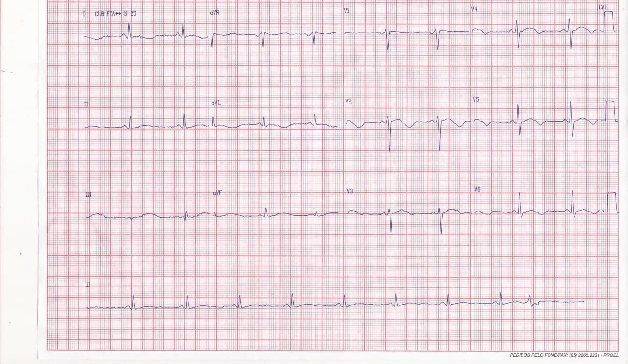 Mujer malaya de 59 años que presenta fiebre, diarrea y vómitos en la que se constata severa hipokalemia
