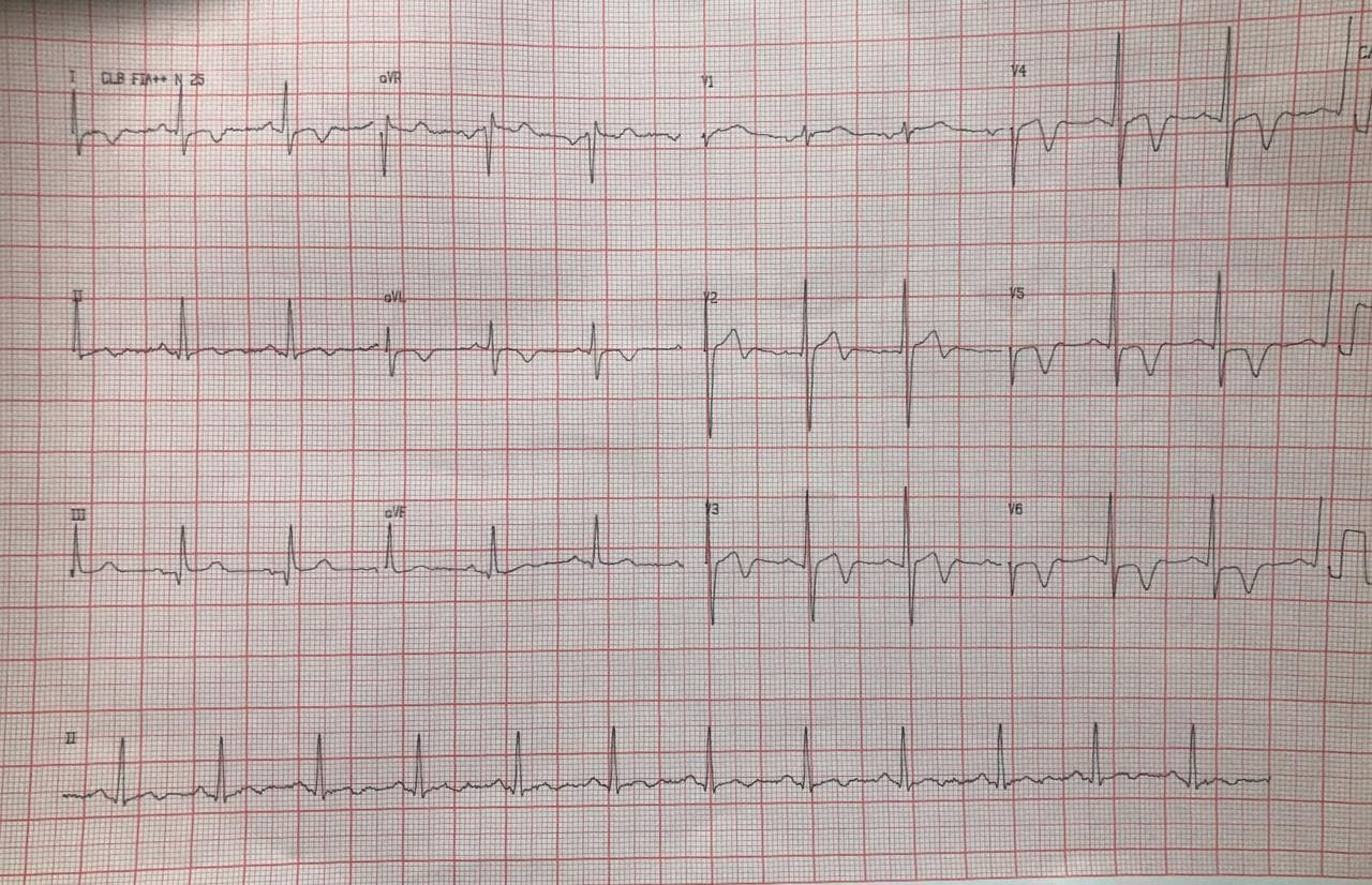 Hombre de 38 años sin comorbilidades que refiere precordialgia atípica y con CCG normal cuyo ECG se interpreta como síndrome de pseudoWellens