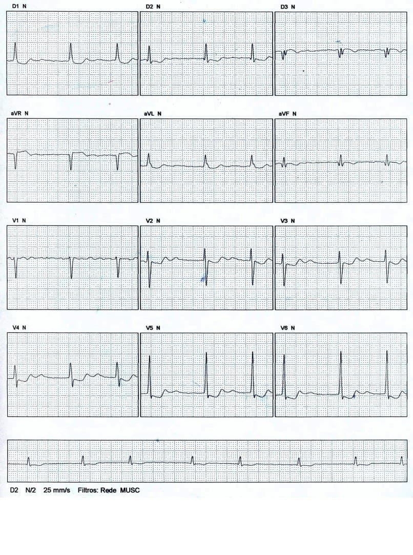 Paciente portador de valvulopatía mitral que es tratado con digital, que manifiesta anorexia y cuyo ECG presenta FA con cierta regularidad en el ritmo y con signos de intoxicación digitálica