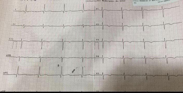 Paciente de 51 años COVID 19 tratado con azitromicina + hidroxicloroquina que desarrolla QTLc