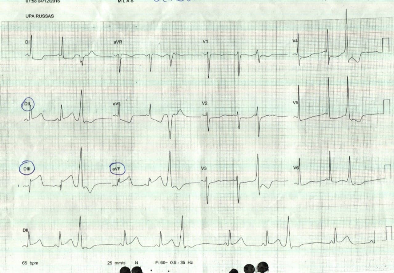Mujer de 56 años con múltiples FR que presenta ángor prolongado que determina se realice CCG en la que se constata compromiso de tres vasos presentando a posteriori BAVC y EAP determinando nuevo estudio que muestra lesión de DA e insuficiencia mitral aguda