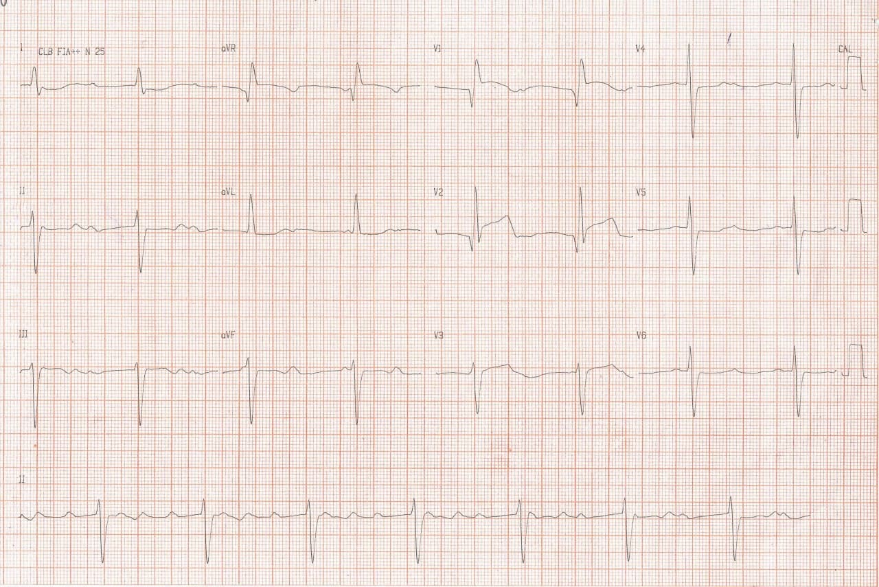 Hombre de 76 años que cursa con SCACEST  al que se le implantan dos stents en DA y en quién se detecta TVS por monitor que requiere CVE, y que a posteriori muestra BAV atribuible a trombosis del stent por abandono de medicación