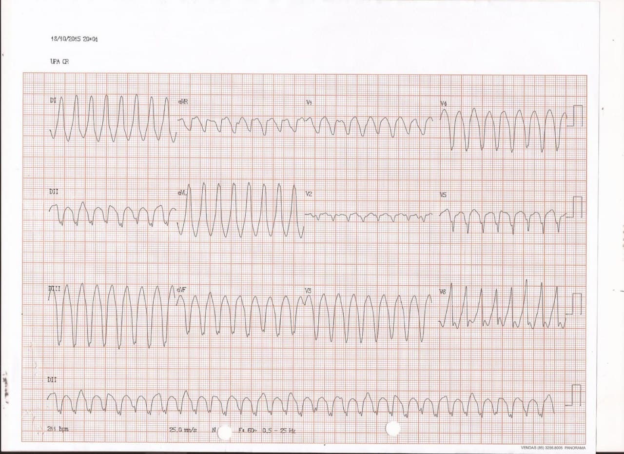 Paciente masculino de 26 años que presenta síncope durante caminata constatándose la presencia de TV originada en VD por DAVD
