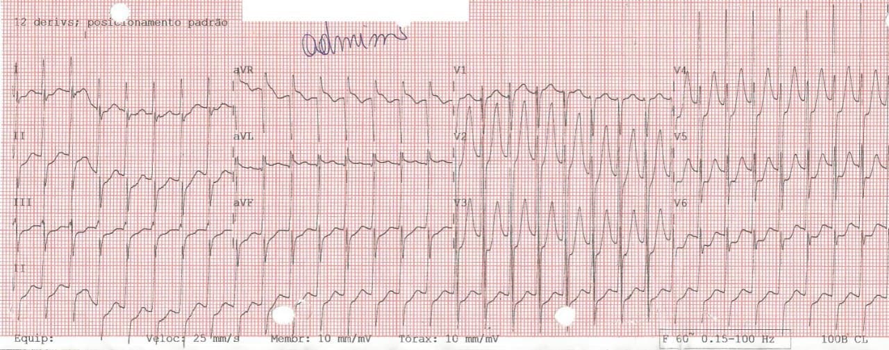 Hombre de 39 años consumidor de alcohol y cocaína que refiere palpitaciones por presencia de TPSV que se controla con adenosina, con arterias coronarias normales y signos de miocardioatía hipertrófica apical