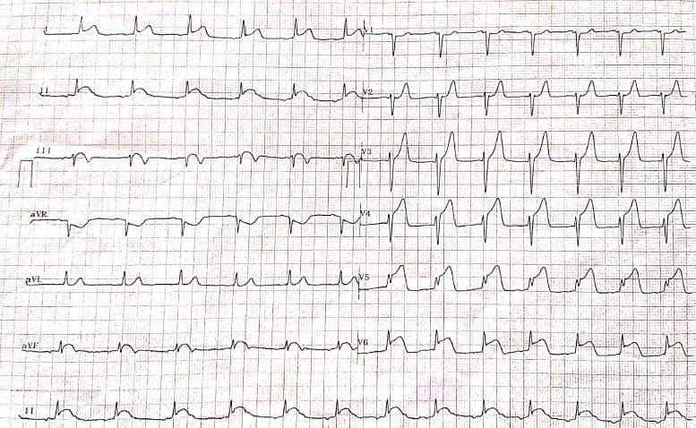 Agricultor de 23 años que sufre picaduras de abeja presentando shock anafiláctico y posterior desarrollo de síndrome de Kounis
