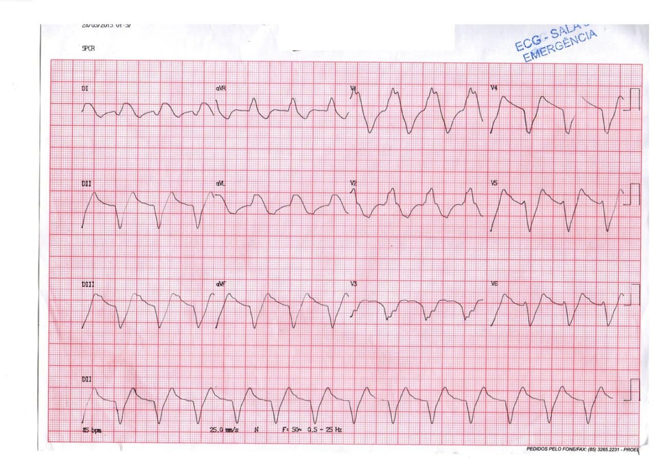Paciente que padece diabetes y enfermedad de Chagas que cursa con severa hiperpotasemia atribuible a su medicación cuyo ECG mejora al corregirse el trastorno electrolítico