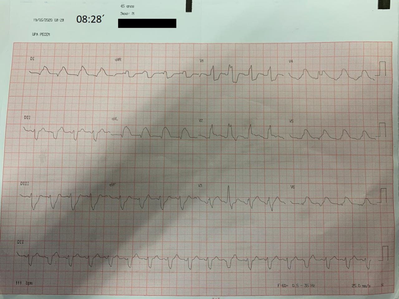 Paciente masculino de 45 años que ingresa en shock cardiogénico por SCA con BCRD + HbAI por probable lesión de TCI que fallece