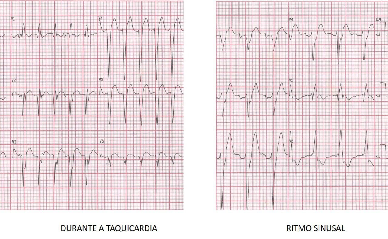 ECG que presenta una TV a cuyo diagnóstico puede arribarse teniendo en cuenta que el ancho de los complejos en ritmo sinusal es mayor