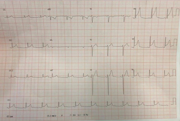 Paciente masculino de 19 años que cursa infección por COVID 19 y manifiesta dolor de tipo pleurítico en quién se constata miopericarditis atribuida a la virosis