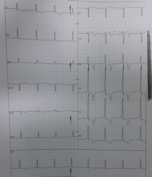 Paciente masculino de 31 años que consulta por dolor precordial, disnea y palpitaciones atribuibles a presencia de mocardiopatía hipertrófica apical de Yamaguchi