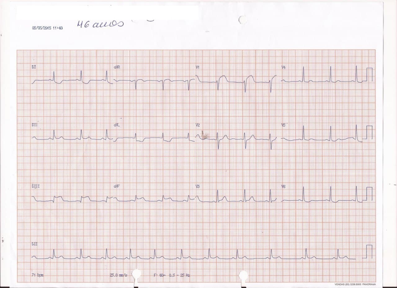 Trazados ECGs correspondientes a compromiso isquémico de VD