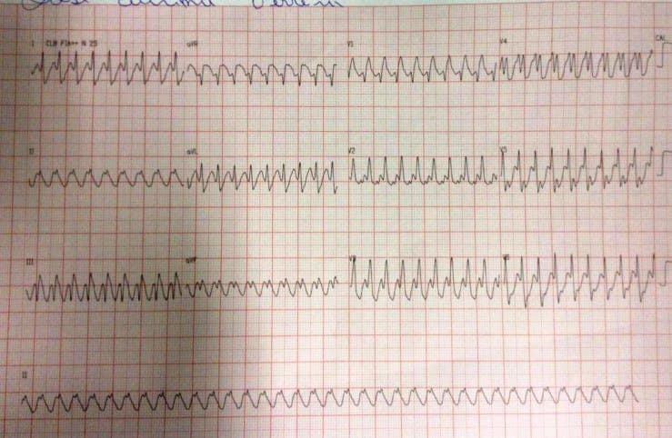 Trazado ECG que corresponde a un aleteo auricular 1:1 que responde a la adenosina aumentando el grado de BAV