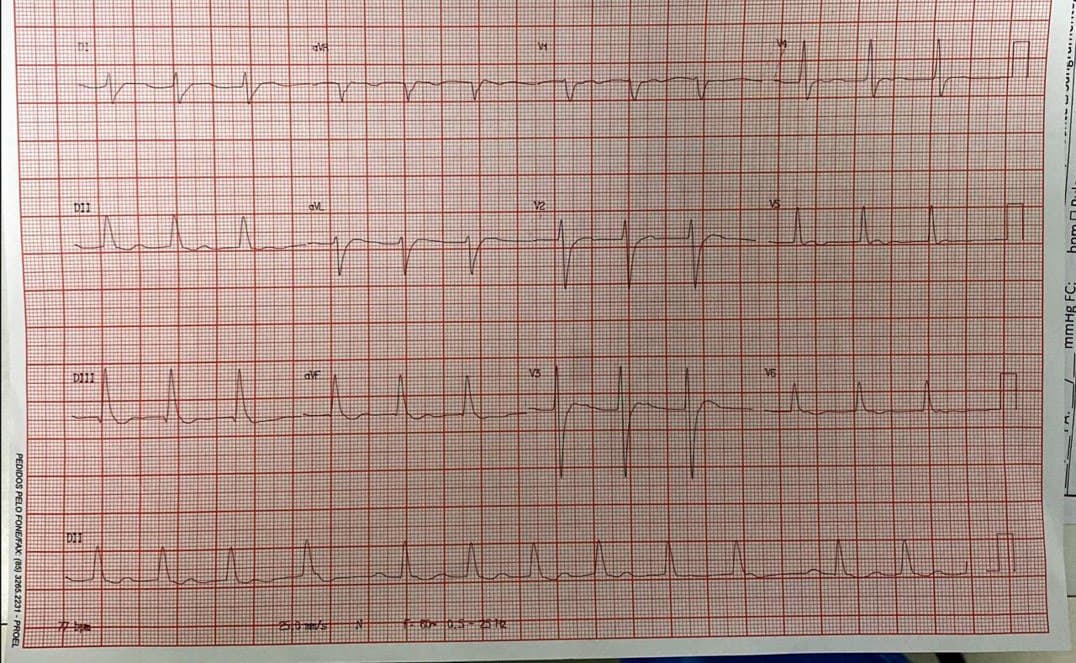 Hombre de 45 años que sufre paro cardiorespiratorio ingresando con FV que requiere CVE y en quién se constata suboclusión en 1/3 medio de CD y obstrucción distal total y obstrucción del 60% de TCI