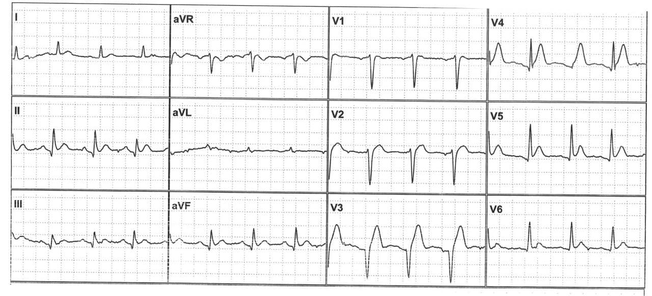 Hombre de 64 años con dolor precordial indefinido que cursa con desorientación, confusión mental y delirio en quién se constata severa hipercalcemia vinculada a la presencia de un mieloma múltiple con CCG normal