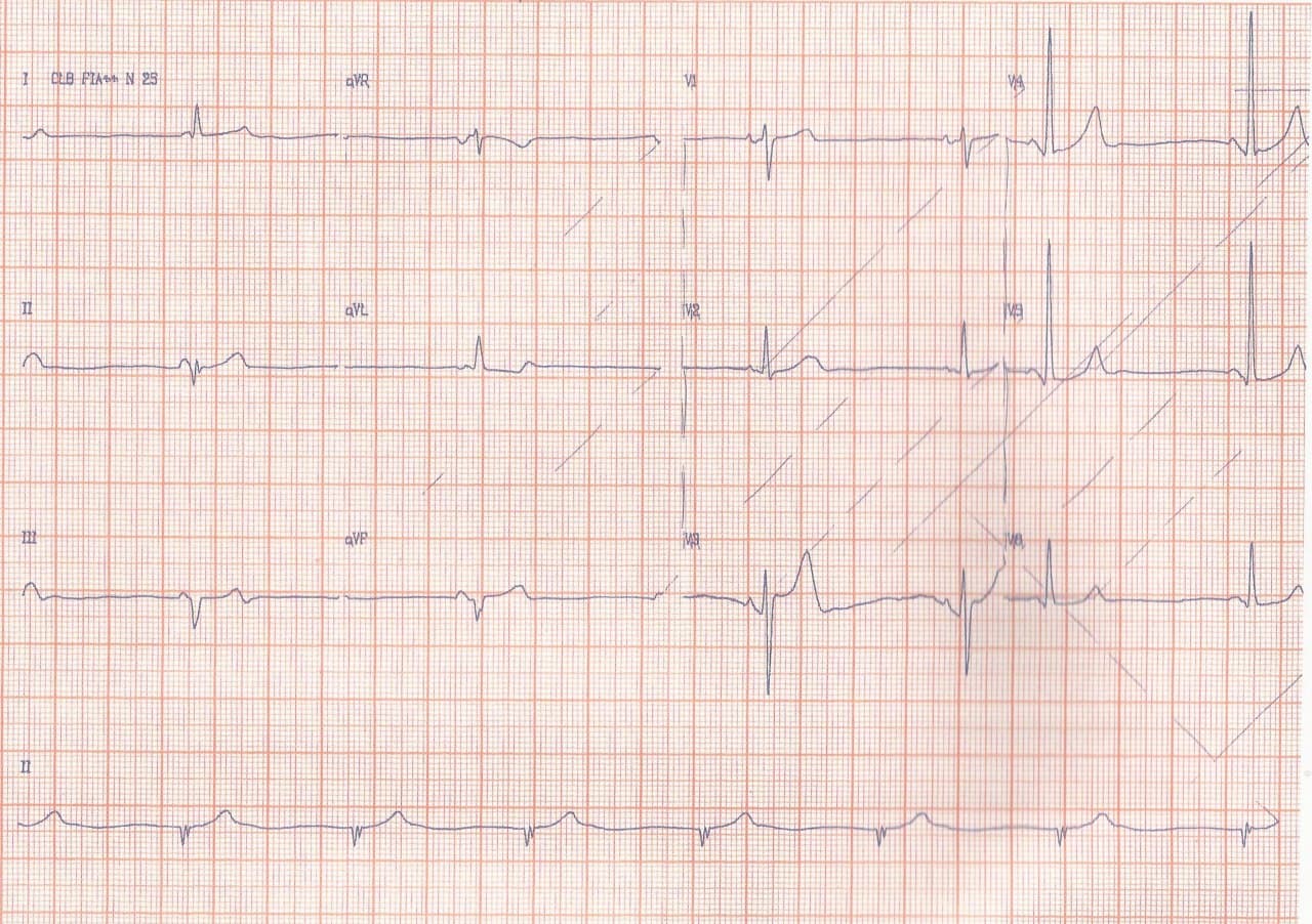 Mujer de 62 años que ingresa por episodio de ángor prolongado que desarrolla BAV de alto grado por oclusión de la CD a la salida de la arteria del nodo sinusal