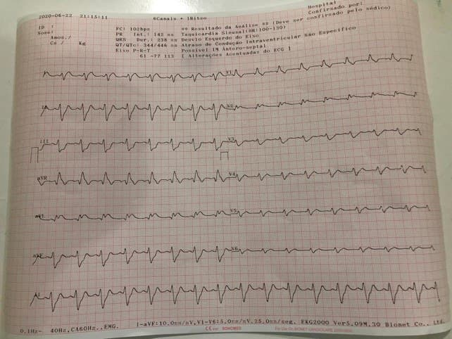 Hombre de 55 años que presenta epigastralgia postprandial y que muestra BRD, HBAI, elevación del ST en aVL y en quién se constata trombo en TCI, oclusión de Cx y suboclusión de 1ª diagonal