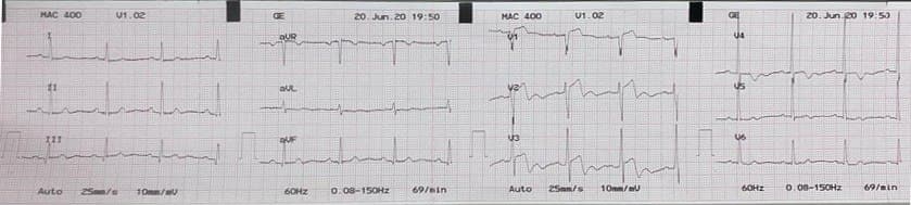 Anciano de 82 años qie presenta episodio de ángor prolongado por SCA debido a suboclusión de la DA