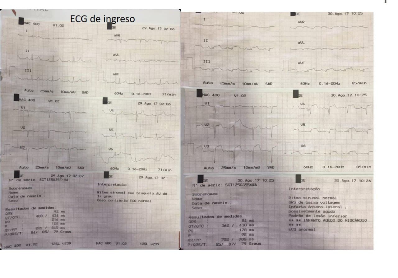 Anciano que padece traumatismo de cráneo desarrollando hematoma intraparenquimatoso derecho y que presenta signos de miocardiopatía por estrés neurogénico (MEN) con CCG normal