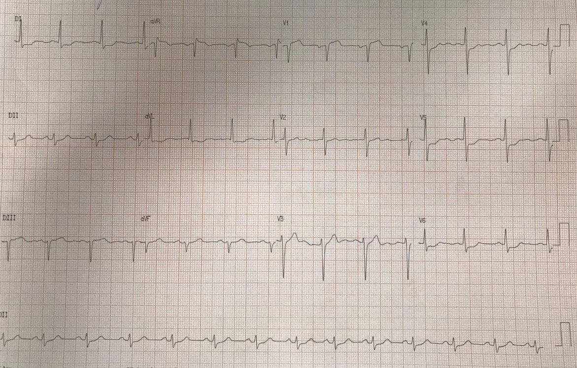 Hombre de 61 años con factores de riesgo que consulta por episodio de ángor que presenta síndrome de Wellens tipo II por suboclusión de la DA