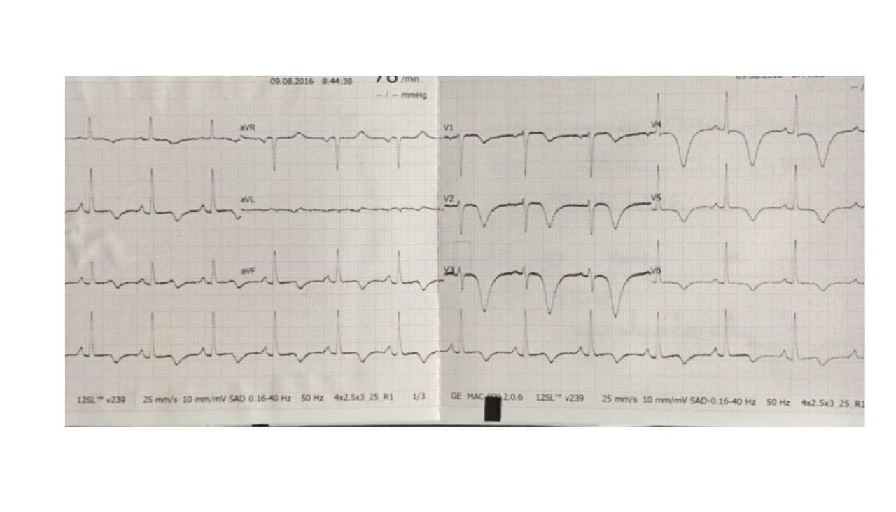 Mujer de 53 años que presenta episodio de ángor post estrés emocional con marcadores positivos de isquemia y arterias coronarias normales en la CCG correspondiendo a síndrome de Tako Tsubo con hipertrofia apical transitoria por edema