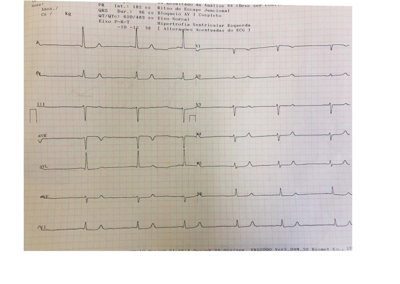 Mujer de 65 años con múltiples factores de riesgo con enfermedad crónica dialitica que presenta severa hperkalemia e hipocalcemia, con derrame pericárdico