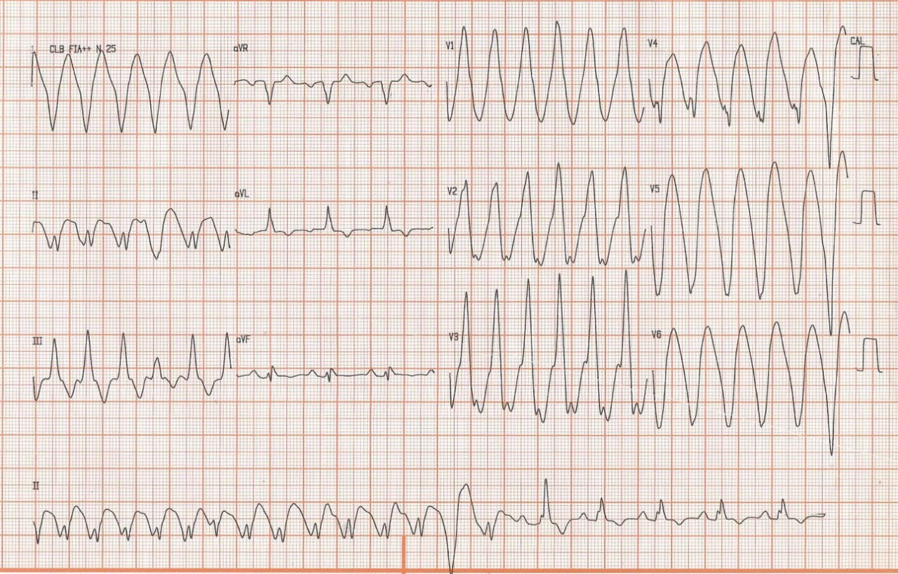 Hombre de 44 años con disnea de esfuerzo y síncope al caminar por presencia de TVNS en contexto de miocardiopatia hipertrófica medioventricular y fibrosis