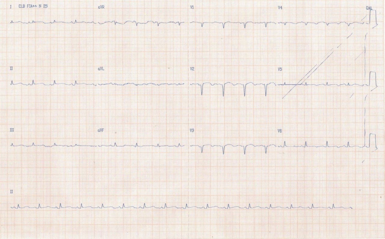 Paciente que presenta ángor post iAM y fiebre atribuible a pericarditis por síndrome de Dressler