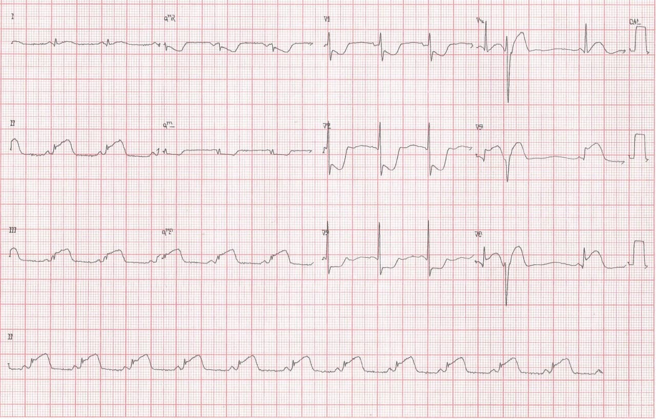 Paciente cursando SCA por compromiso de la arteria Cx
