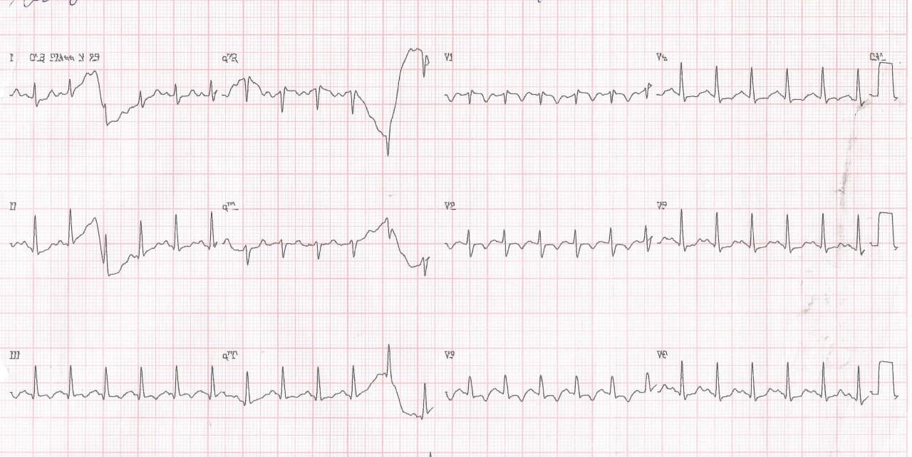 Paciente que consulta por disnea y dolor toráccico agudo por desarrollo de TEP