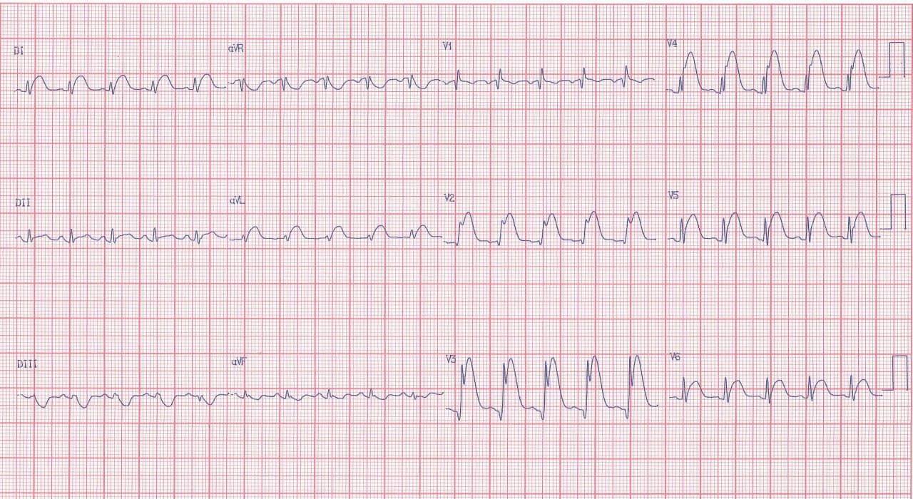 Paciente de 45 años con ángor prolongado por presencia de SCA que se complica por desarrollo de TV que es revertida saliendo con BRD por oclusión de DA proximal
