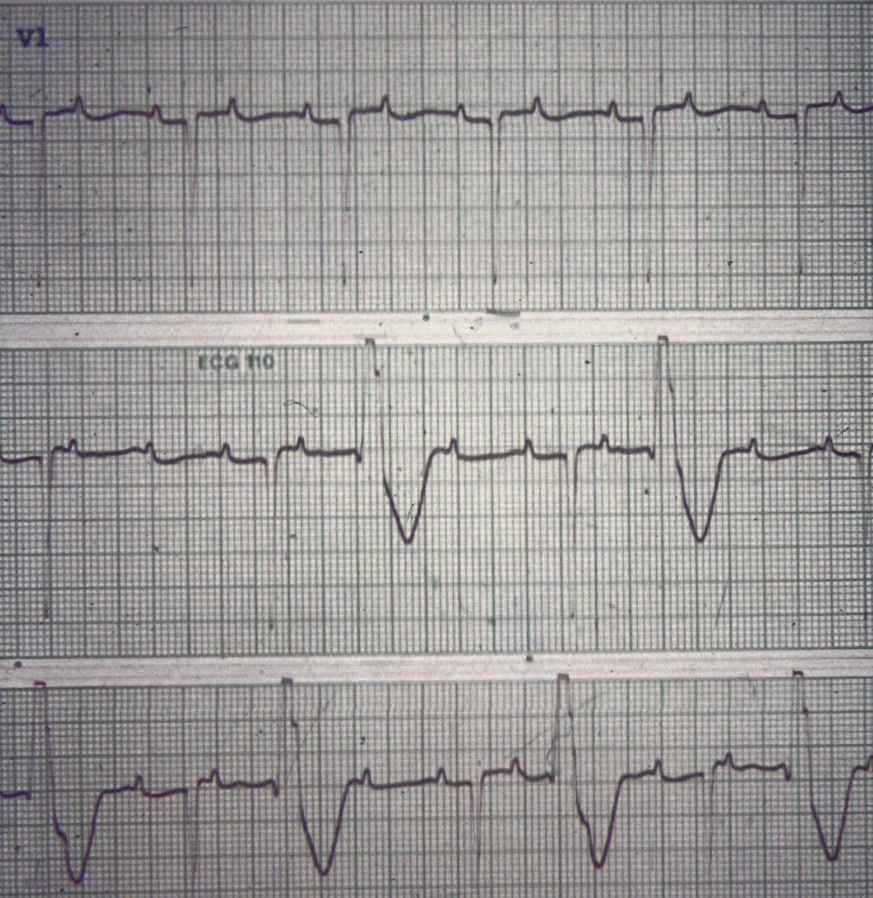 Hombre de 79 años con náuseas y vómitos como expresión de intoxicación digitálica que presenta taquicardia auricular con BAV y frecuentes latidos ectópicos ventriculares que ocurren en un patrón de bigeminia ventricular