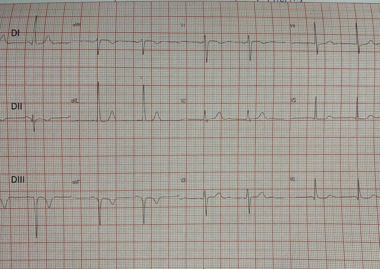 Hombre de 42 años, HTA, que presenta wpisodio de ángor seguido de síncope en quién se constata espasmo de arteria CD